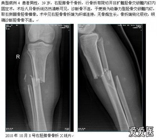 动静力交换型胫骨交锁髓内钉治疗胫骨骨折 骨科与显微外科专业讨论版 爱爱医医学论坛