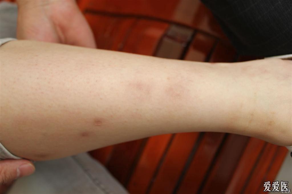 今日遇到的几个皮肤病高清图