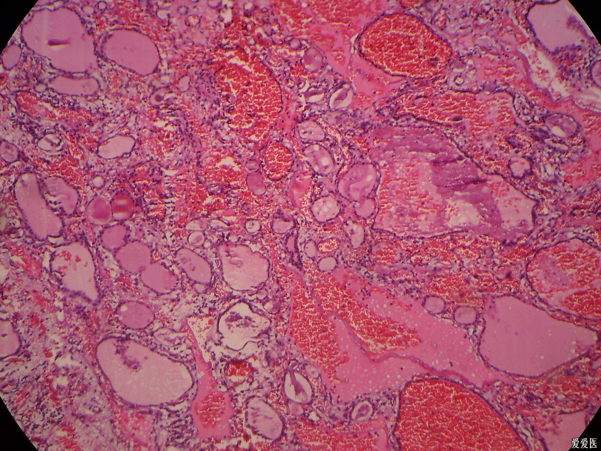 甲状腺腺瘤切片图片