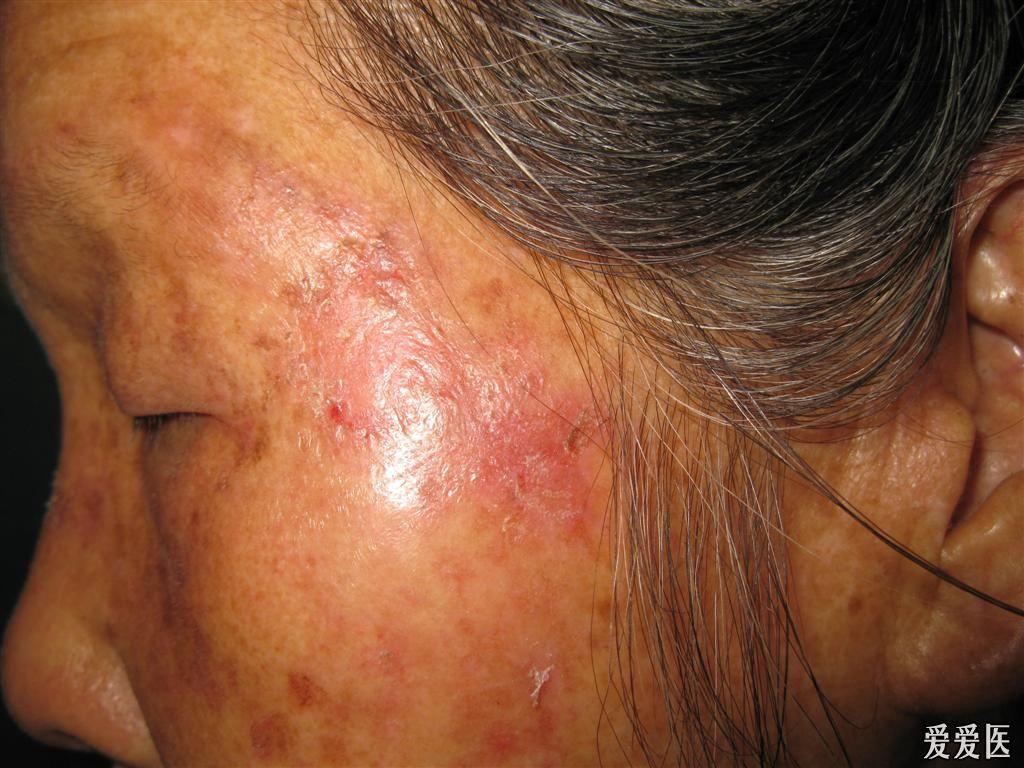 看图识病红斑狼疮