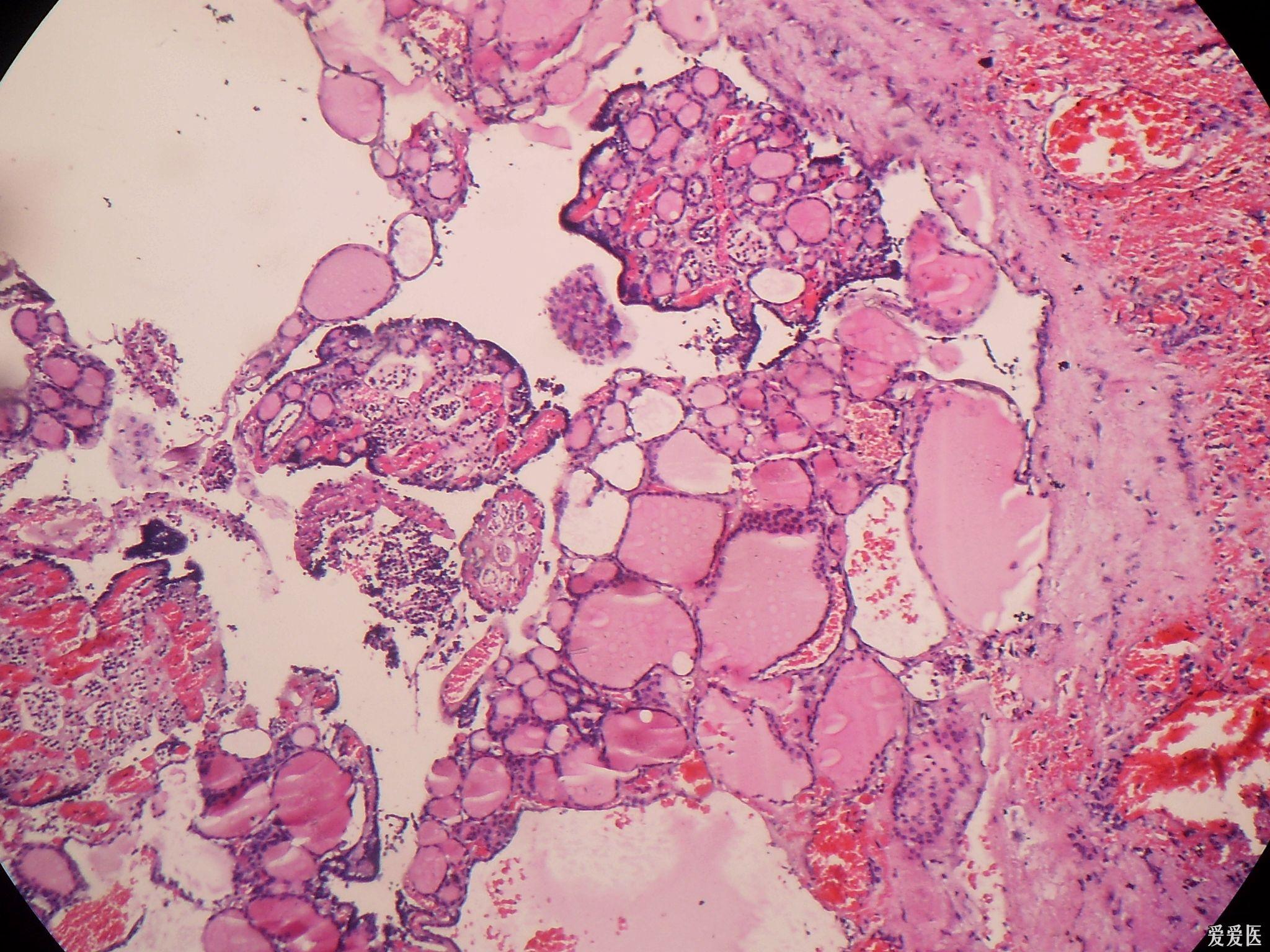 结节性甲状腺肿病理图片