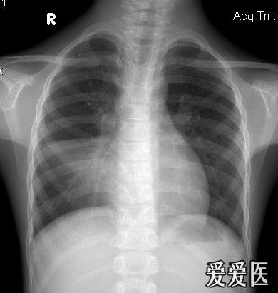 大叶性肺炎x线图片