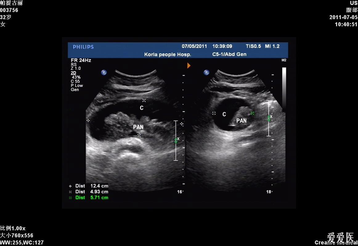 结石性胰腺炎合并胰腺假性囊肿形成