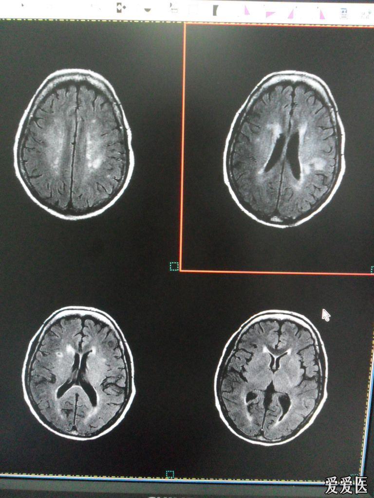 年轻人脑白质变性图片