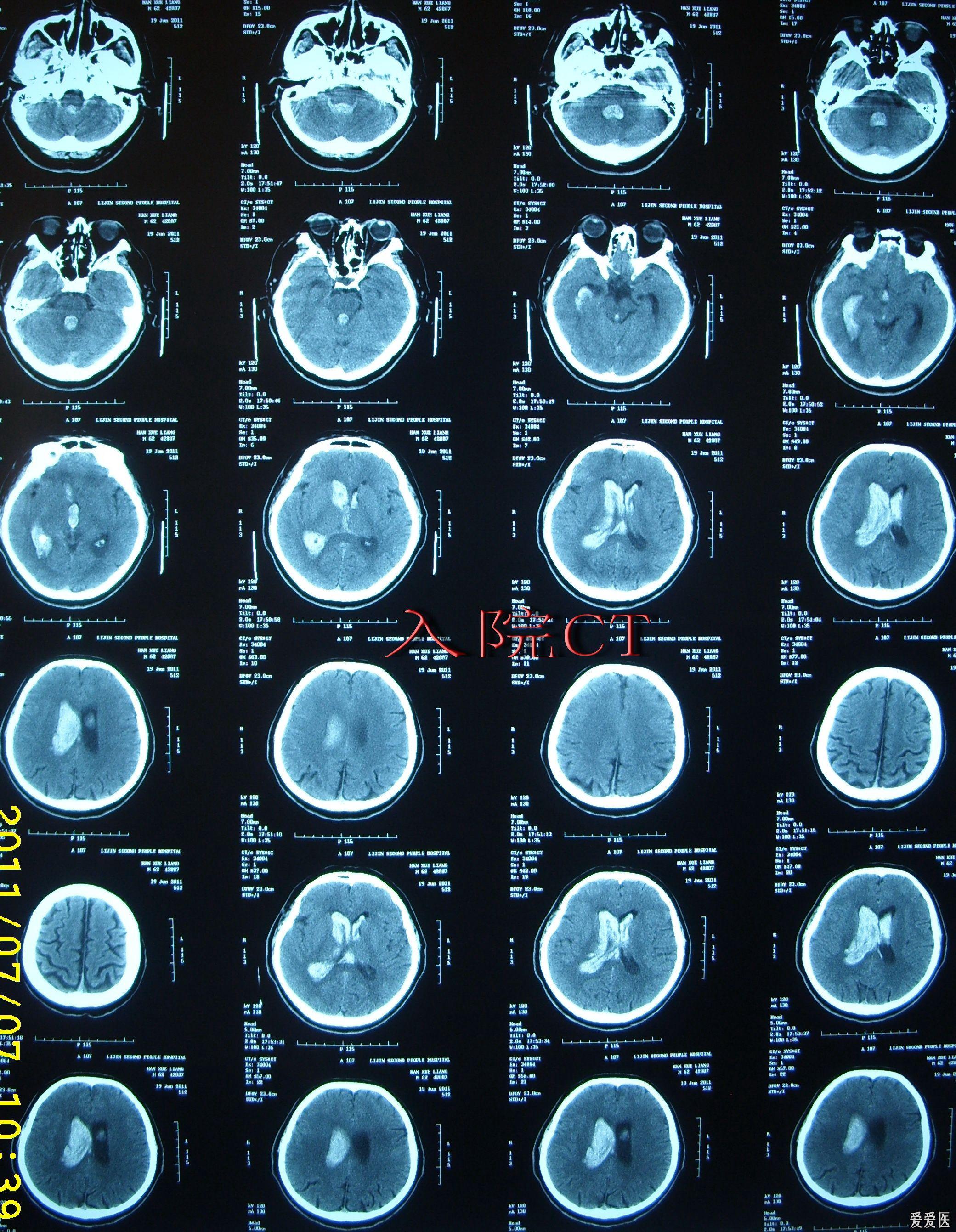 高血压脑出血并破入脑室脑室铸型