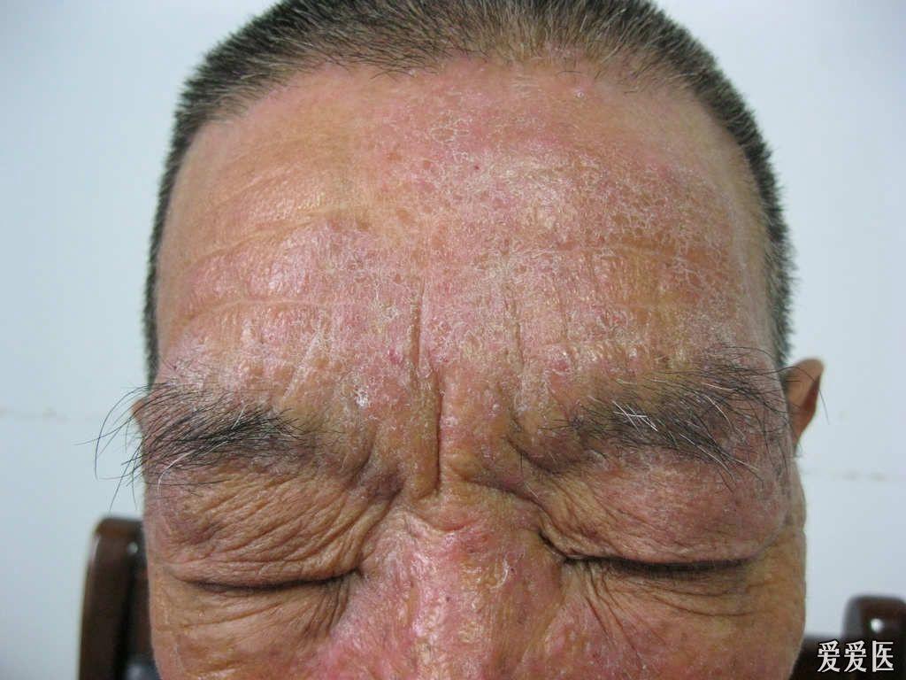 老年患者皮损 - 皮肤及性传播疾病讨论版 - 爱爱医医学论坛