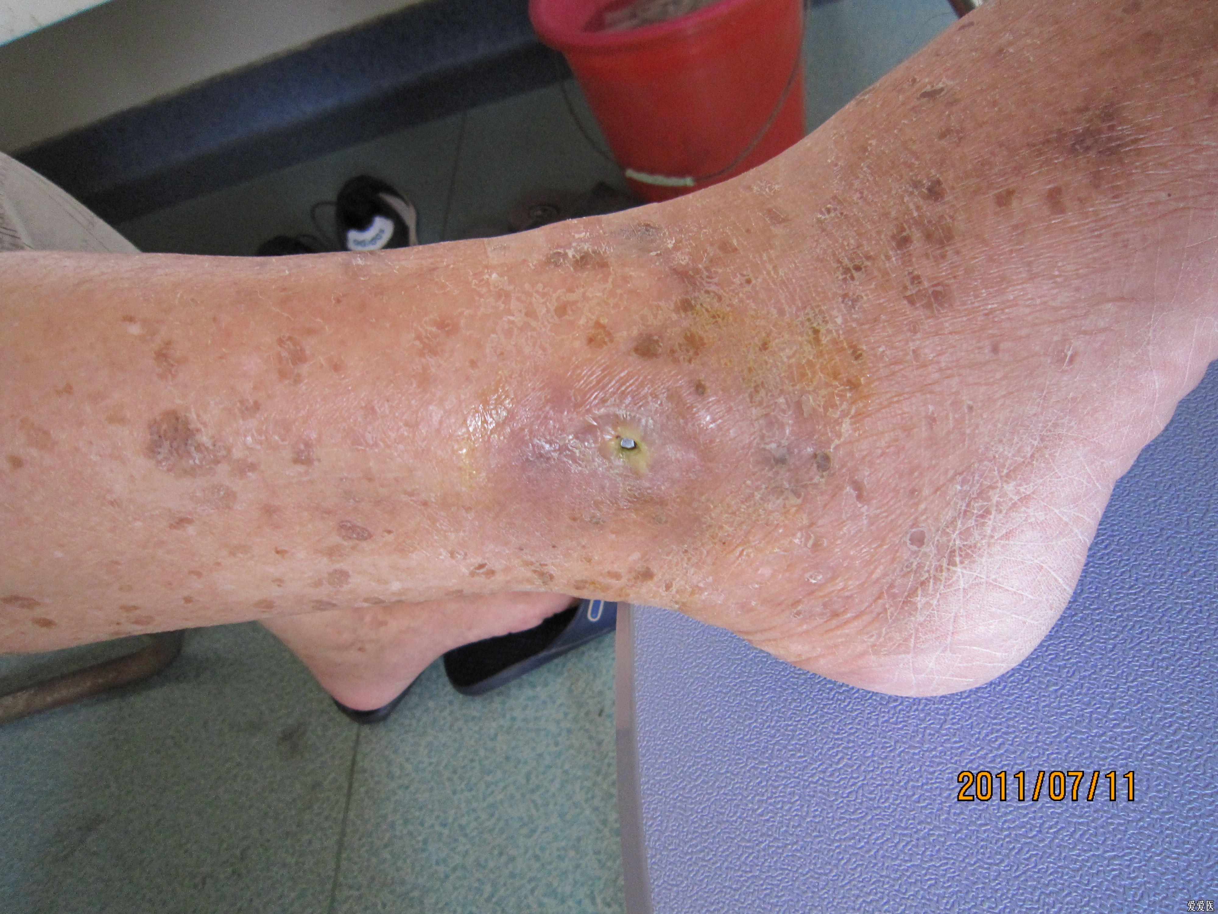 胫腓骨骨折内固定术后伤口不愈合 骨科与显微外科专业讨论版 爱爱医医学论坛