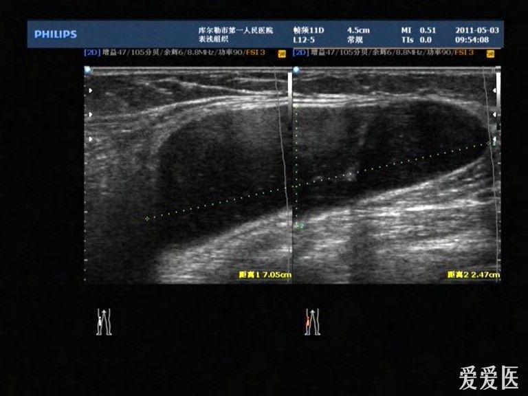 腘窝囊肿 超声医学讨论版 爱爱医医学论坛