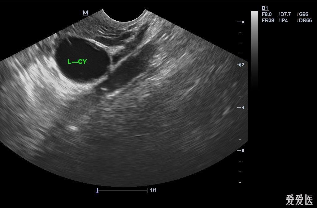 卵巢冠囊肿超声图片图片