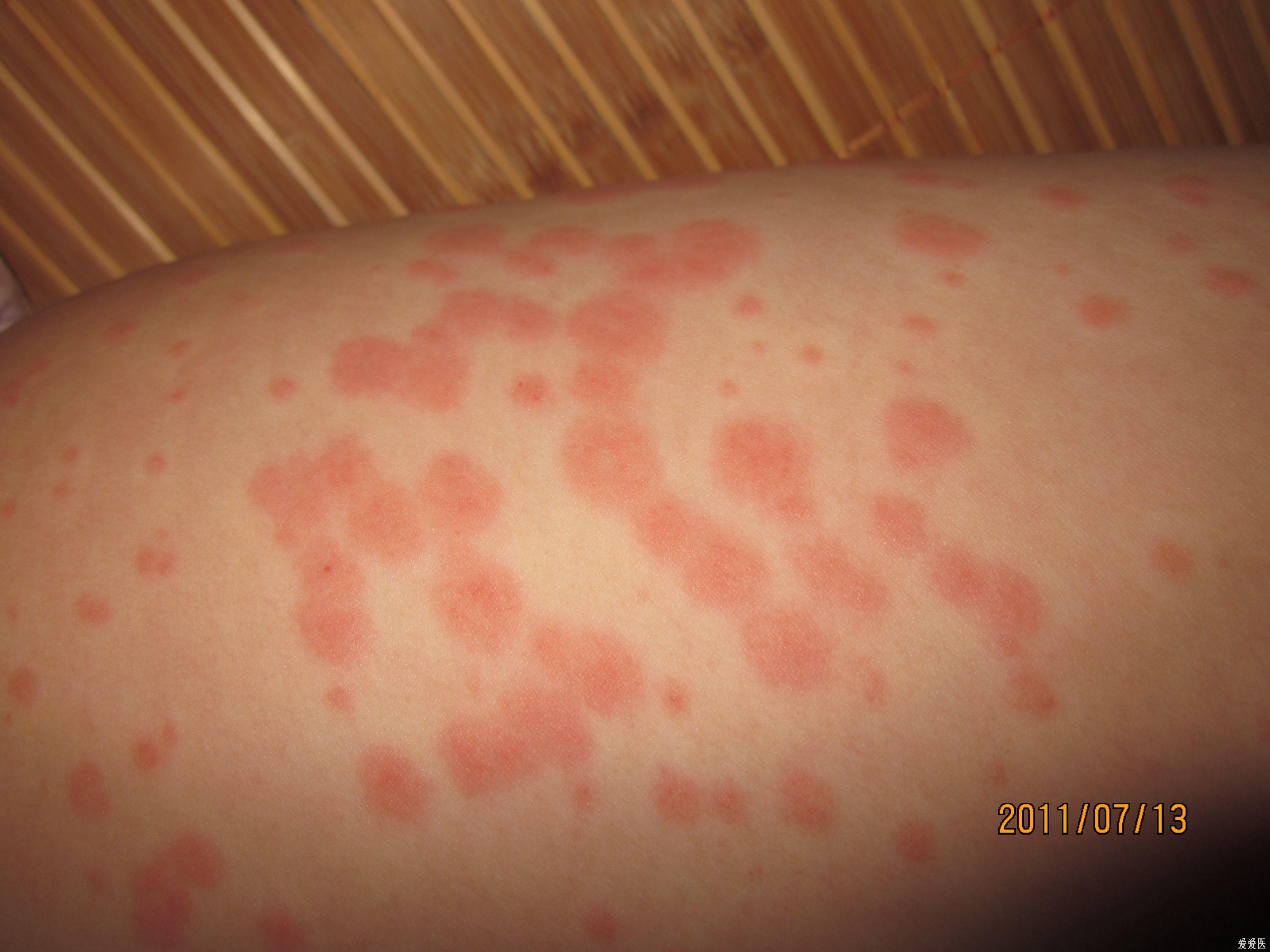 红斑点是什么皮肤病图片
