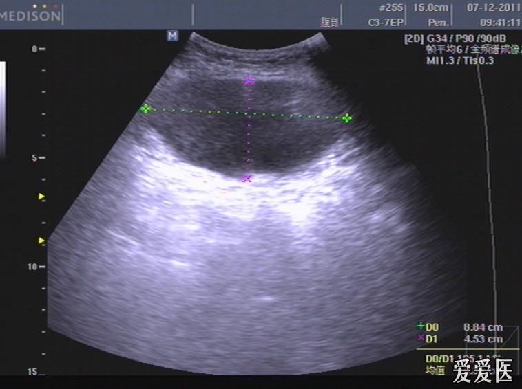 腹壁血肿一例 - 超声医学讨论版 - 爱爱医医学论坛