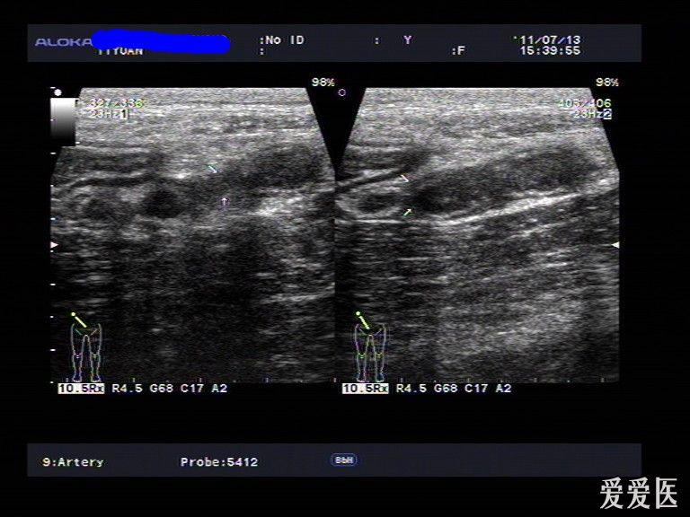 真的很典型——"腊肠型"阑尾. - 超声医学讨论版 - 爱爱医医学论坛