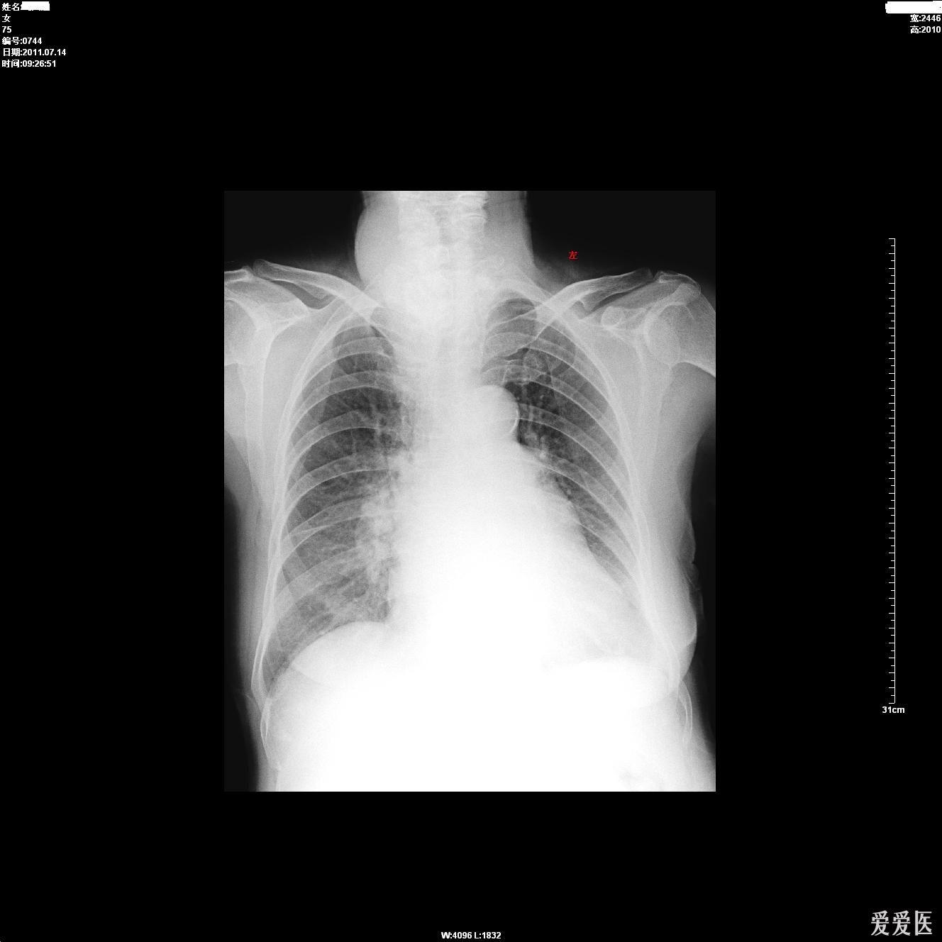 請各位老師看一下這張胸片