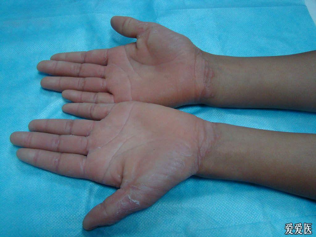 手足对称性红斑角化症图片