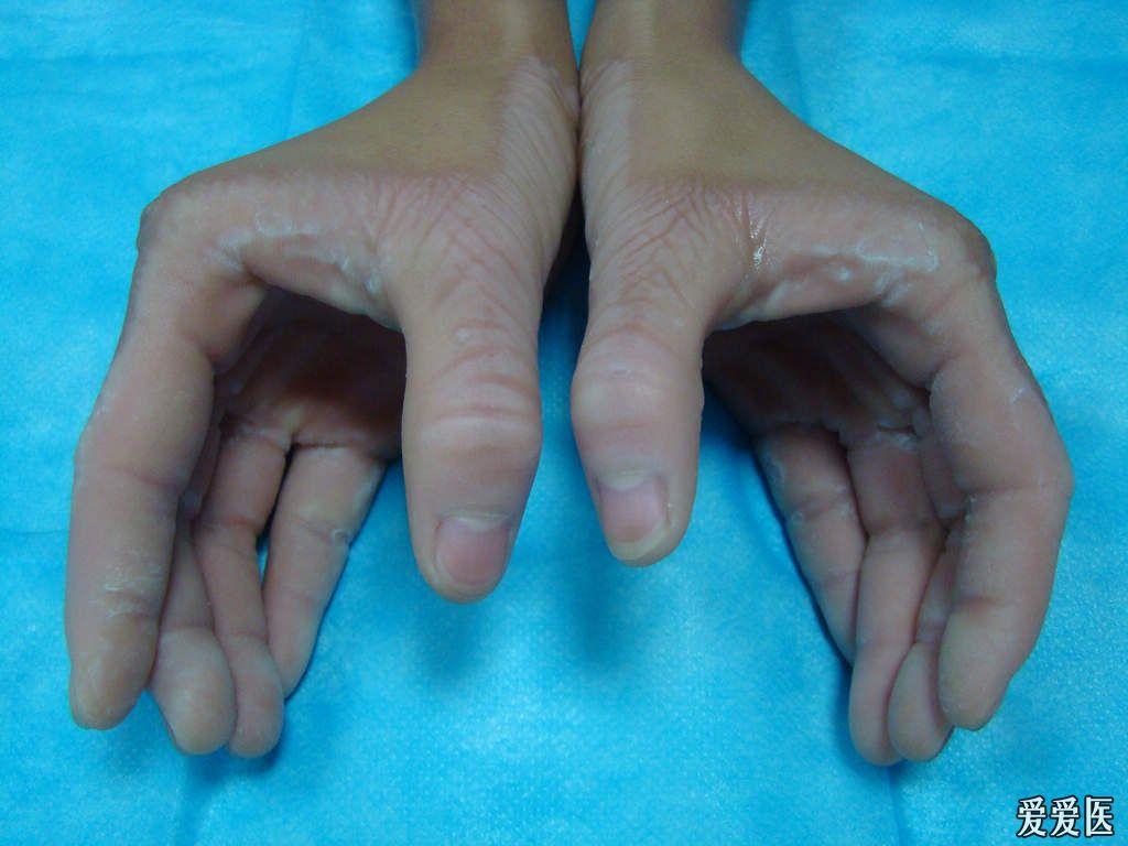 病例讨论双手足红斑角化过度