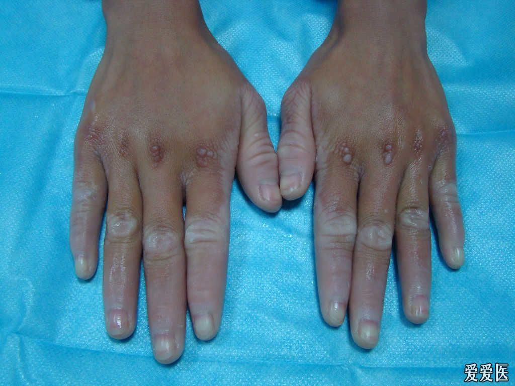 手足对称性红斑角化症图片