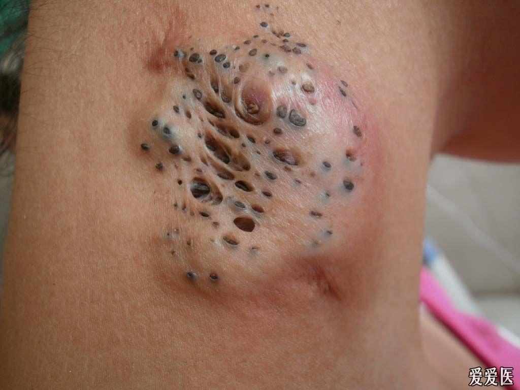粉刺瘤初期图片