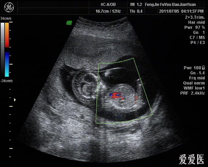 胎儿颈部淋巴水囊瘤图片