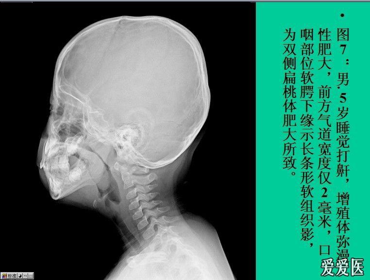 颈椎侧位片诊断腺样体增生的价值
