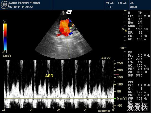 原发性房间隔缺损 - 超声医学讨论版 - 爱爱医医学论坛