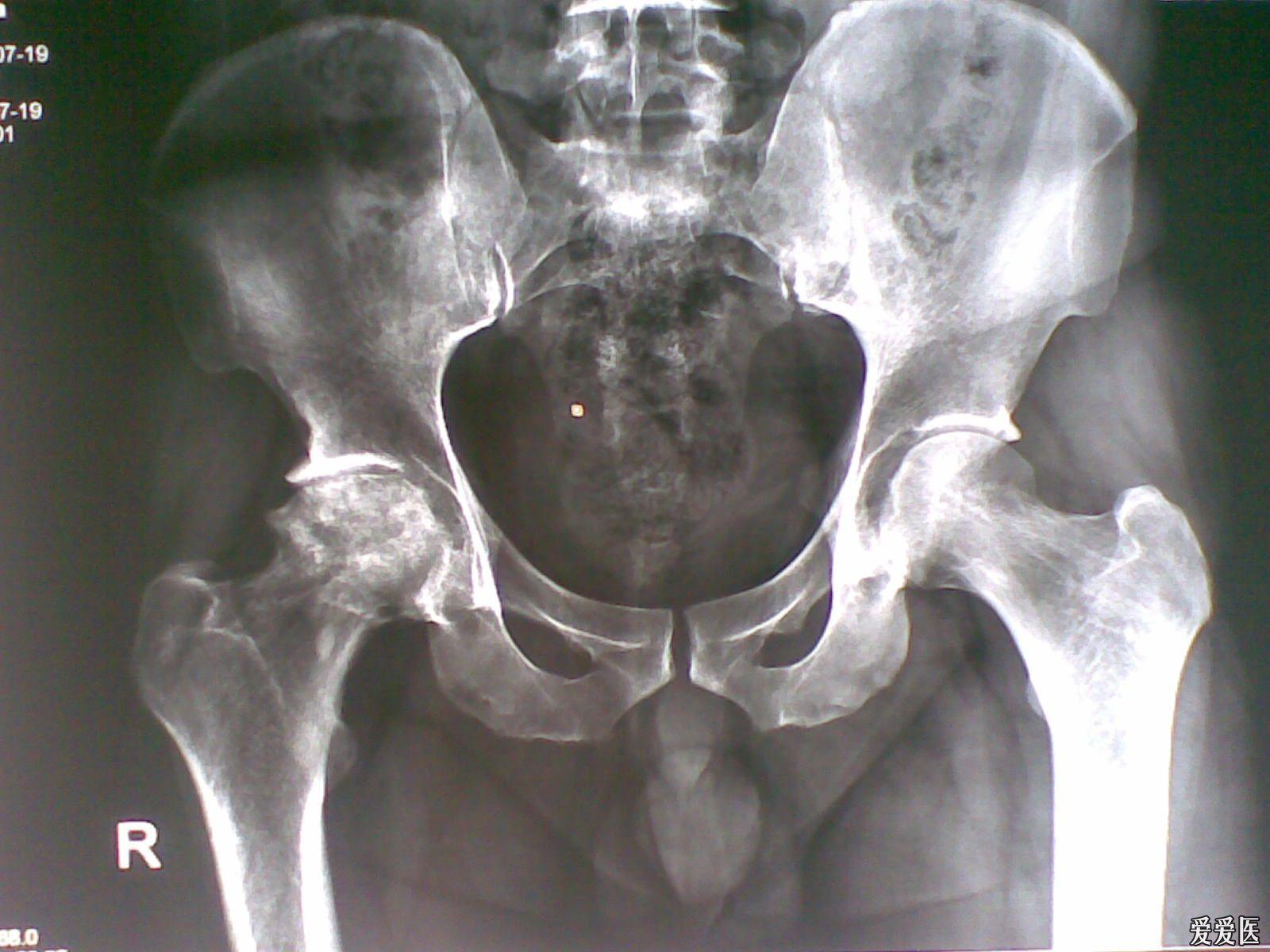 股骨ct图像图片