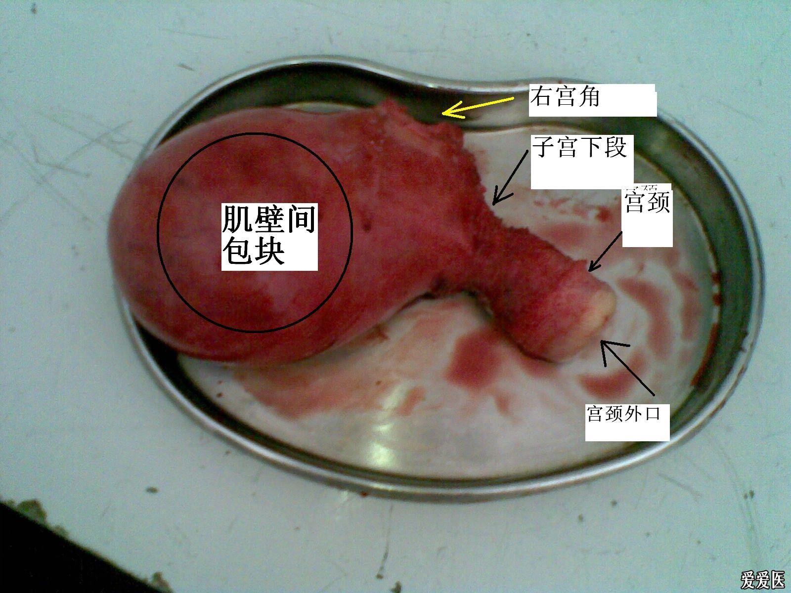 子宫肌瘤囊性样变图片