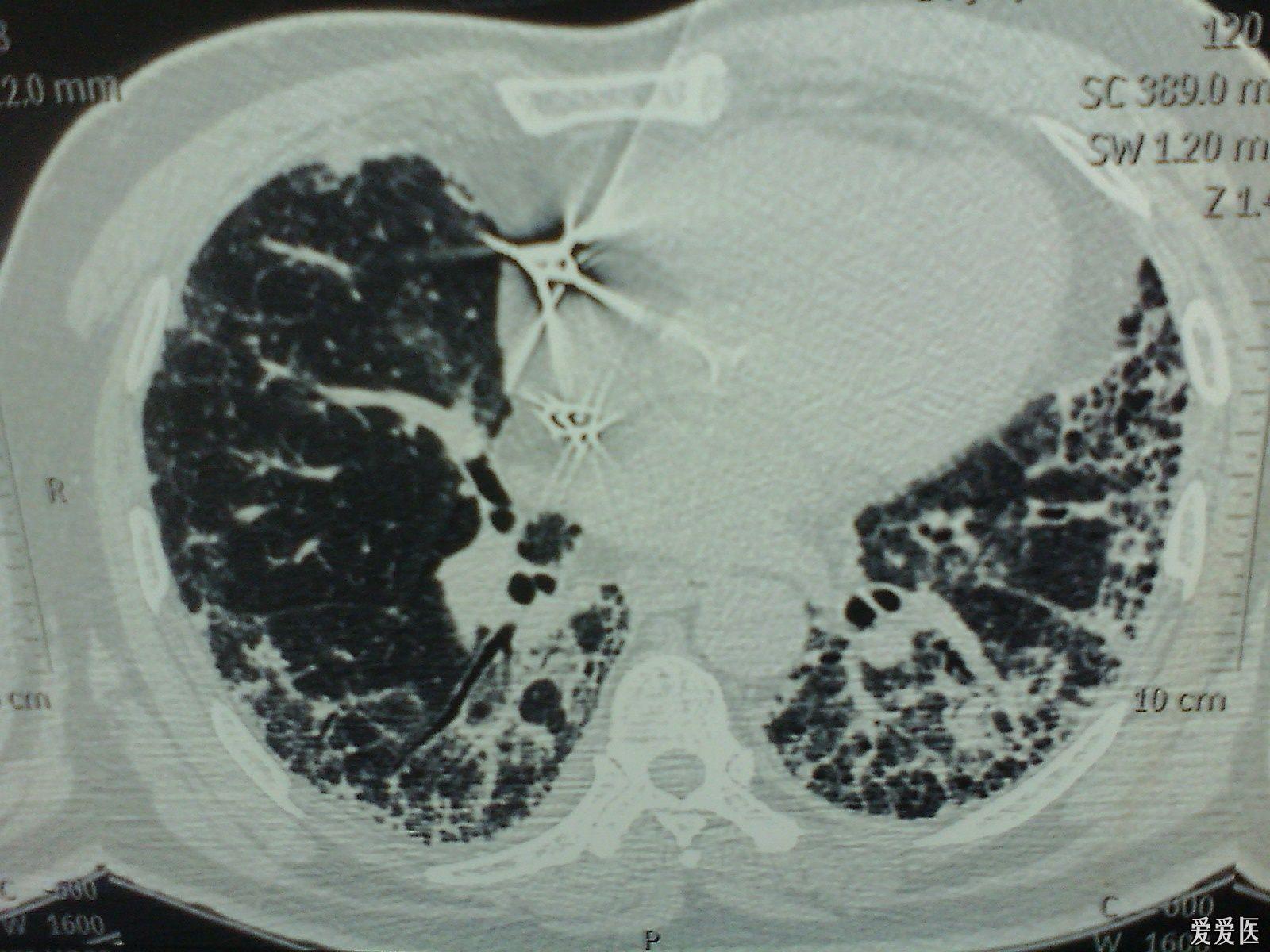 肺纤维化胸片图片
