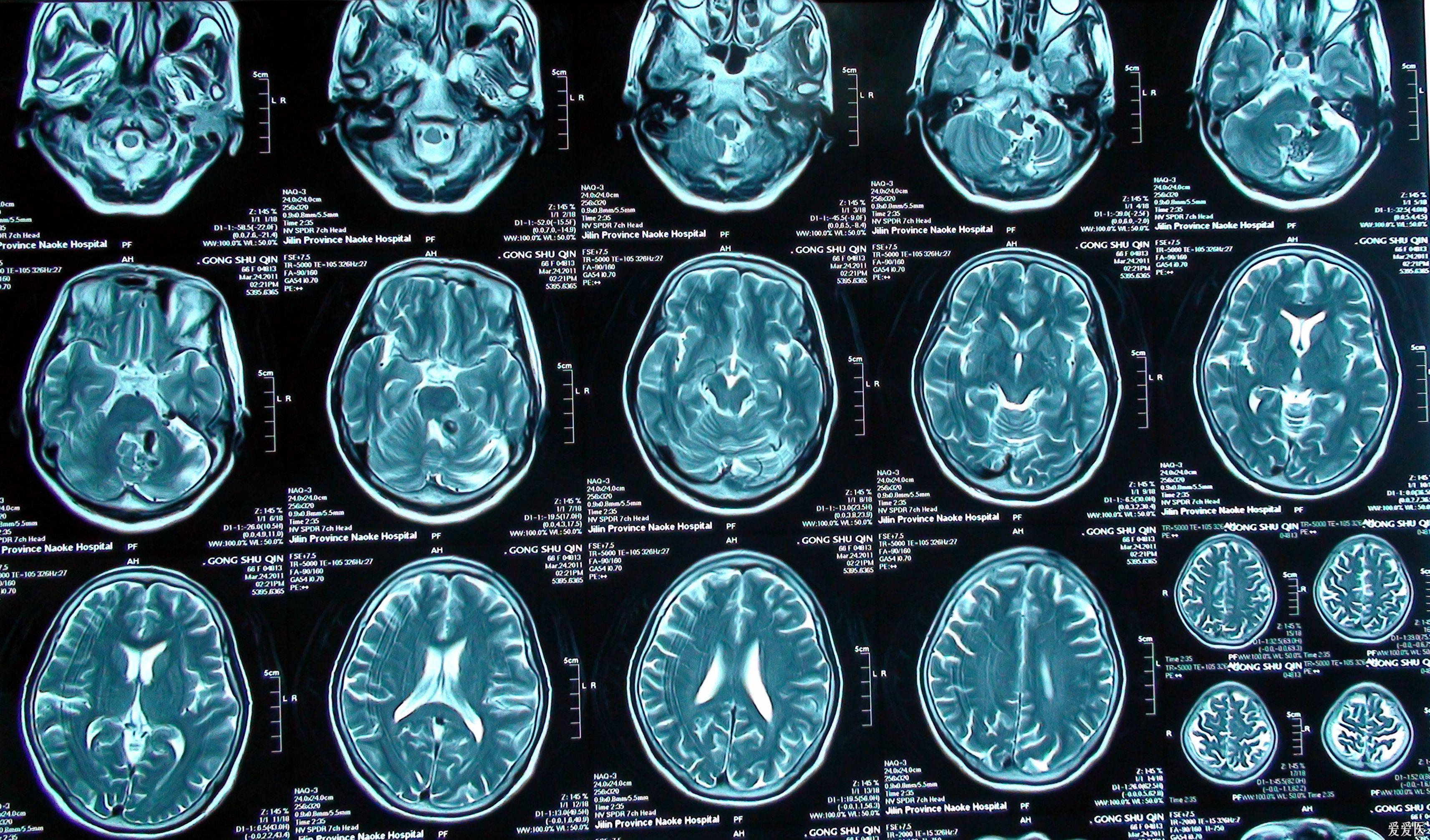 女性66岁头部外伤2小时头部ct检查附加患者以往检查资料