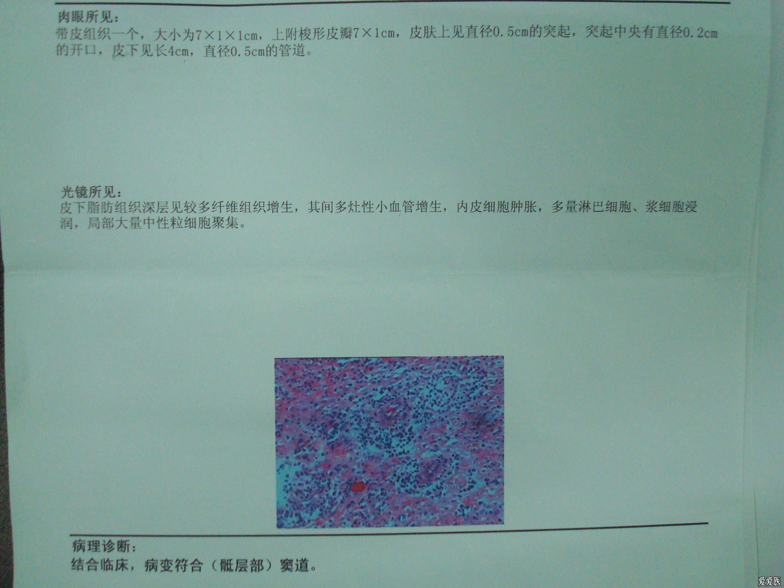 分享一例少见的典型藏毛窦即骶尾部窦道病例