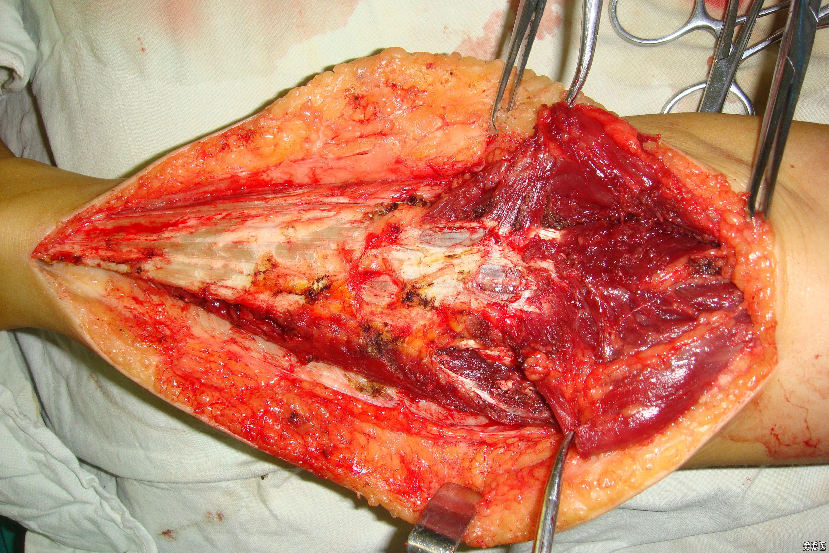 小腿肌肉血管瘤图片