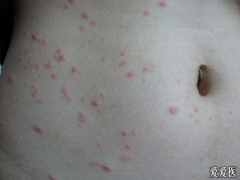 水痘疫苗后皮疹图片图片