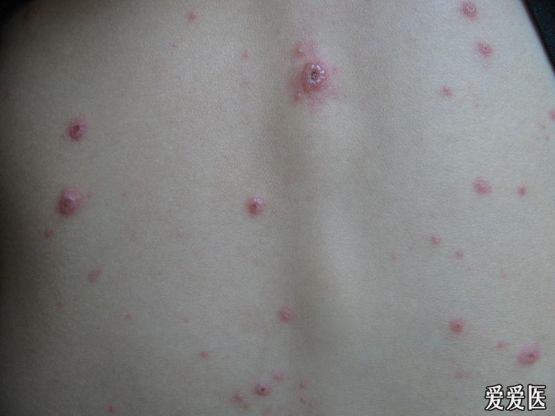 小护士值班后出现皮疹成人水痘