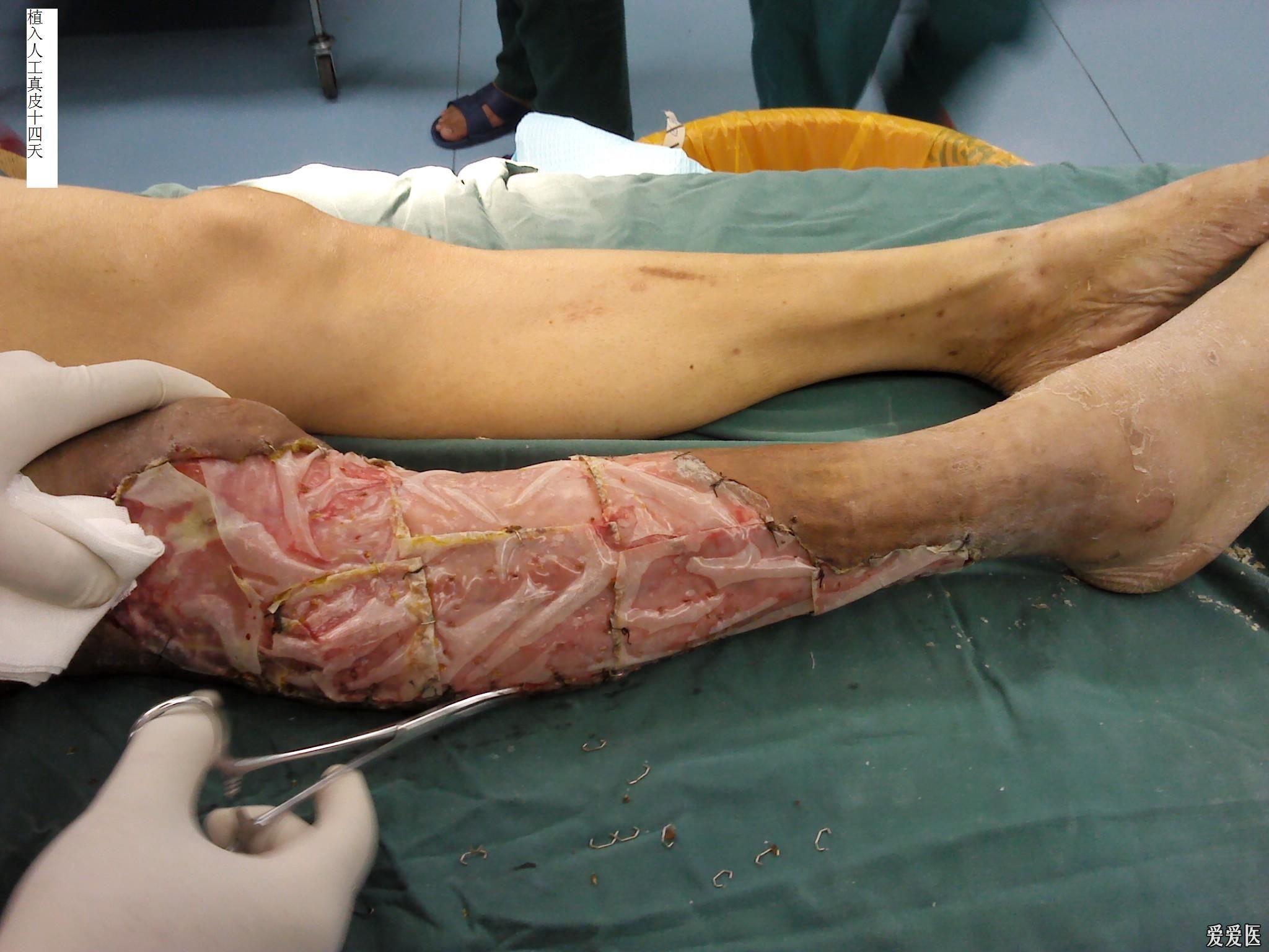 人工真皮治疗下肢脱套伤