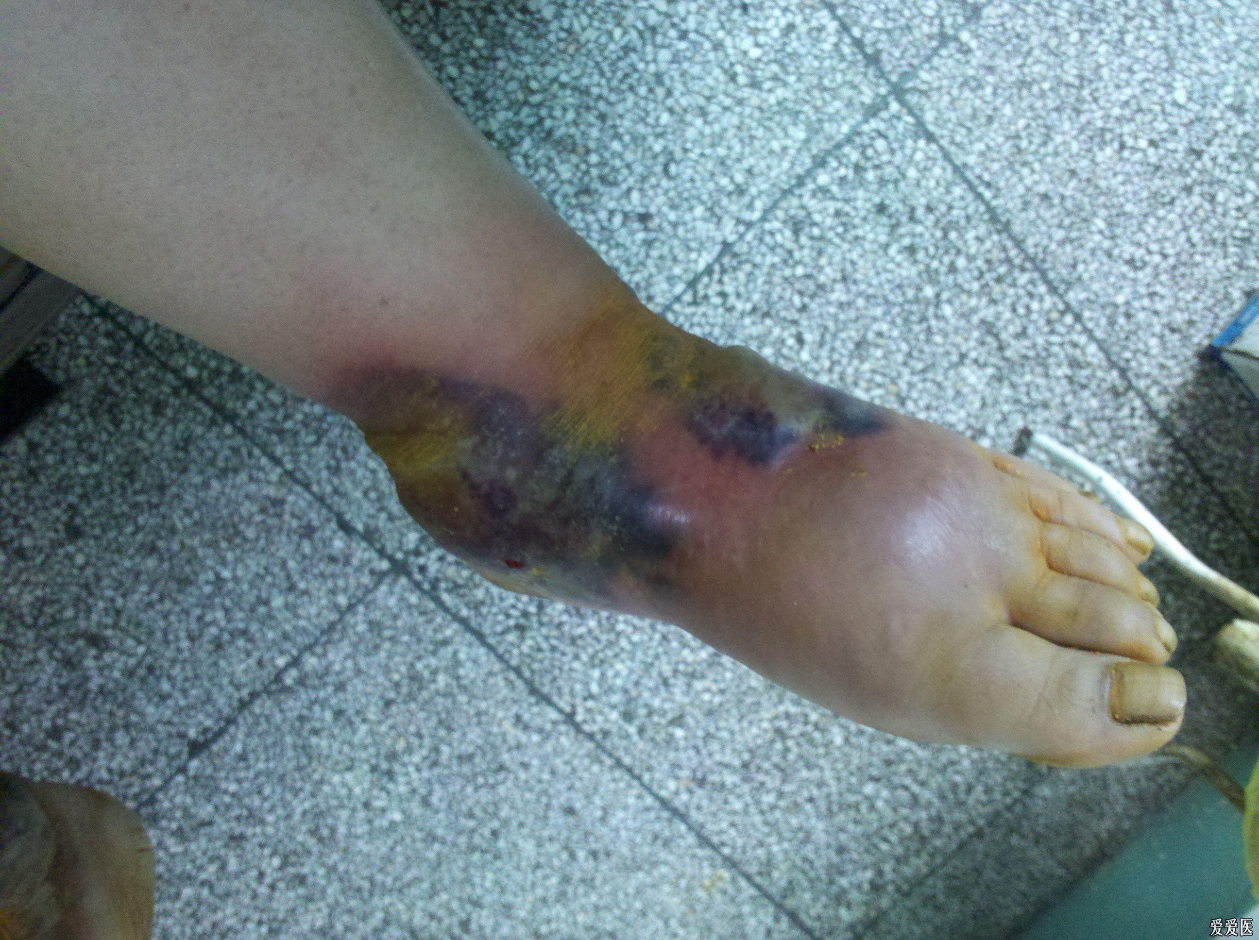 皮肤外科足部溃疡感染3月