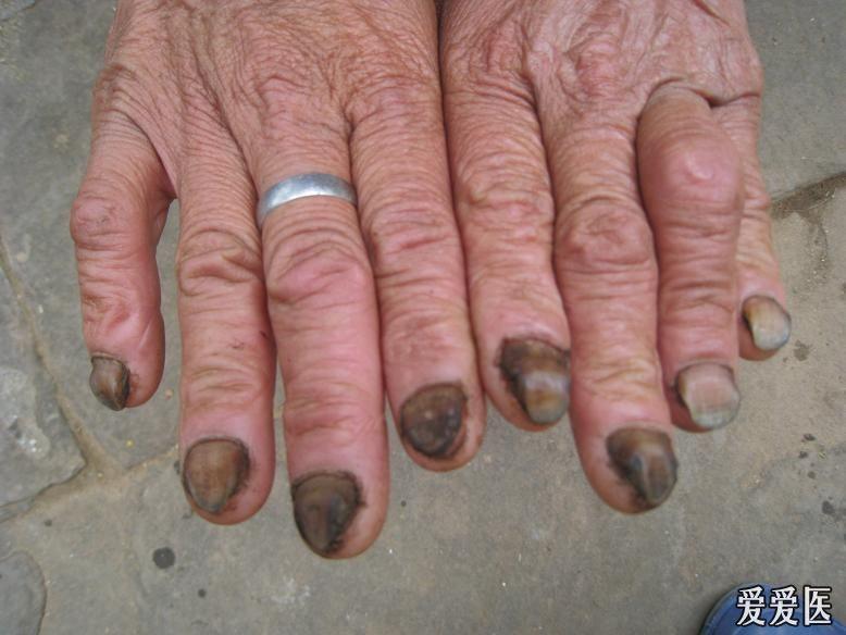 献图诊断灰指甲