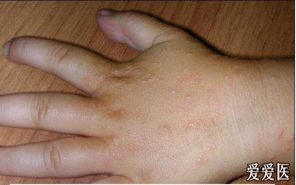 摩擦性苔藓样疹(大把鲜花感谢)—各位斑竹,帮一下忙!