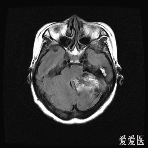 头部核磁忘了脱内衣_头部核磁