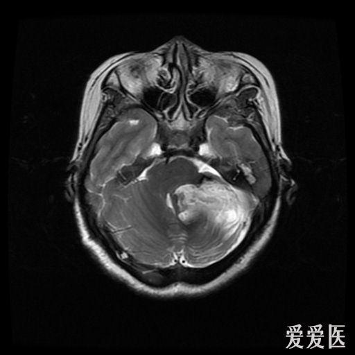 头部核磁忘了脱内衣_头部核磁