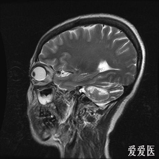 头部核磁忘了脱内衣_头部核磁