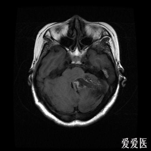 头部核磁忘了脱内衣_头部核磁