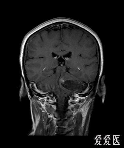 头部核磁忘了脱内衣_头部核磁