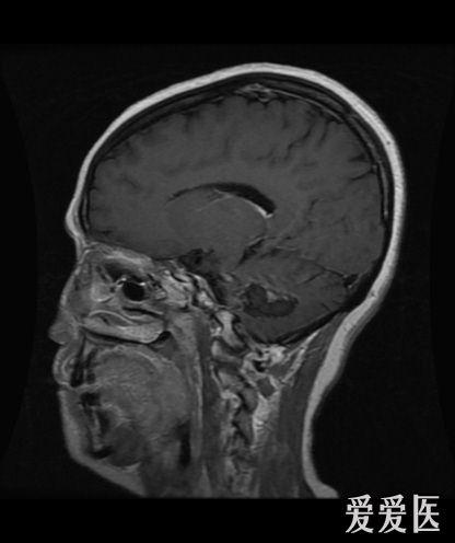 头部核磁忘了脱内衣_头部核磁