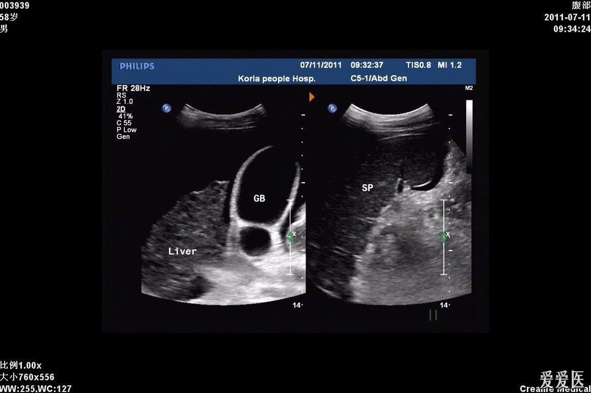 肝硬化声像图表现图片