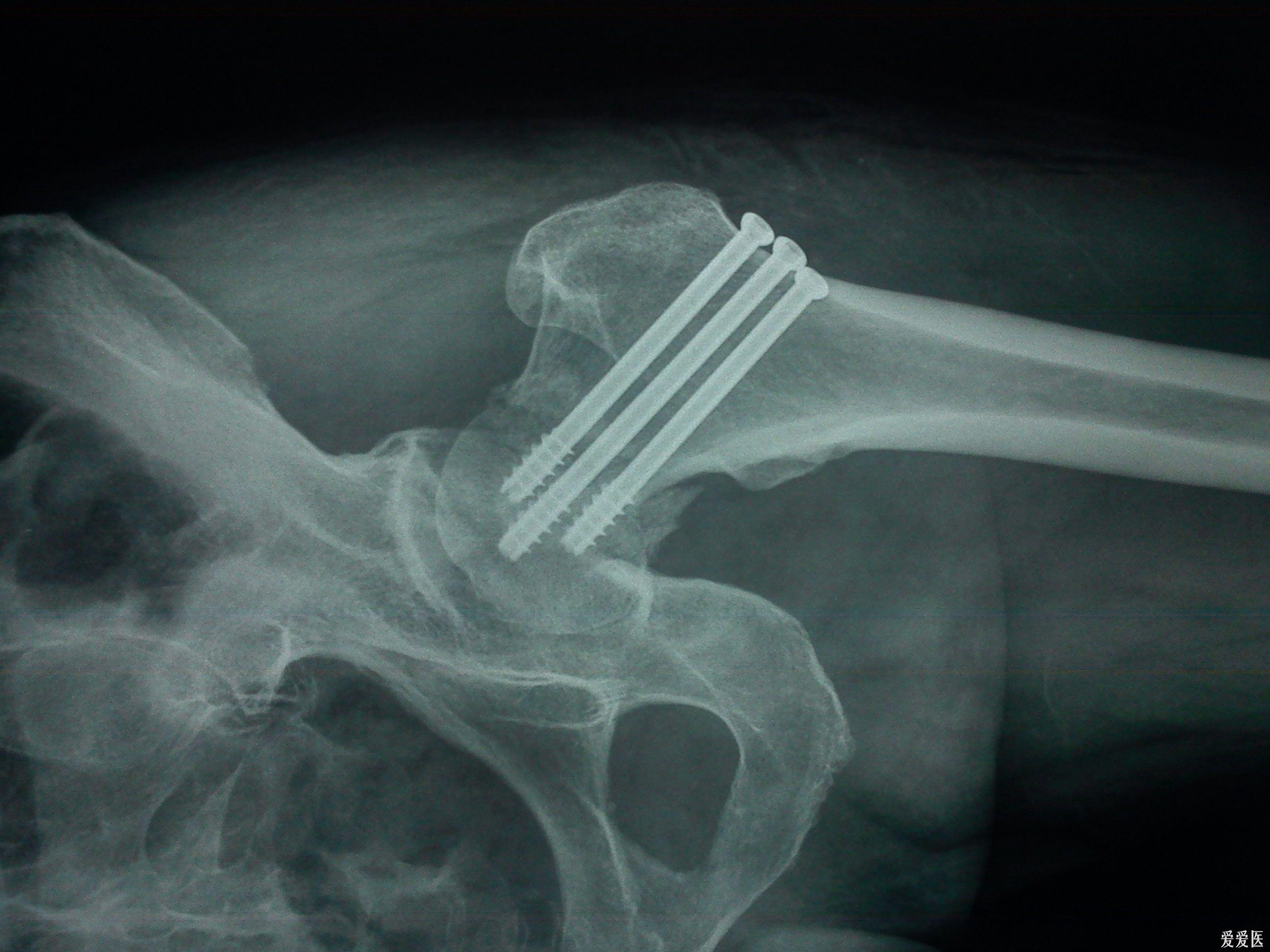 股骨颈骨折手术评估