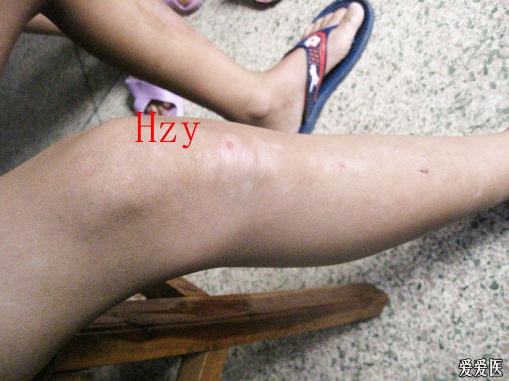 看图诊病----------白色糠疹 - 皮肤及性传播疾病讨论版 - 爱爱医医学