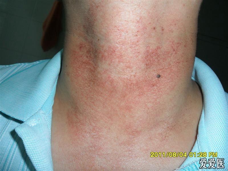 梅毒二期 脖子图片