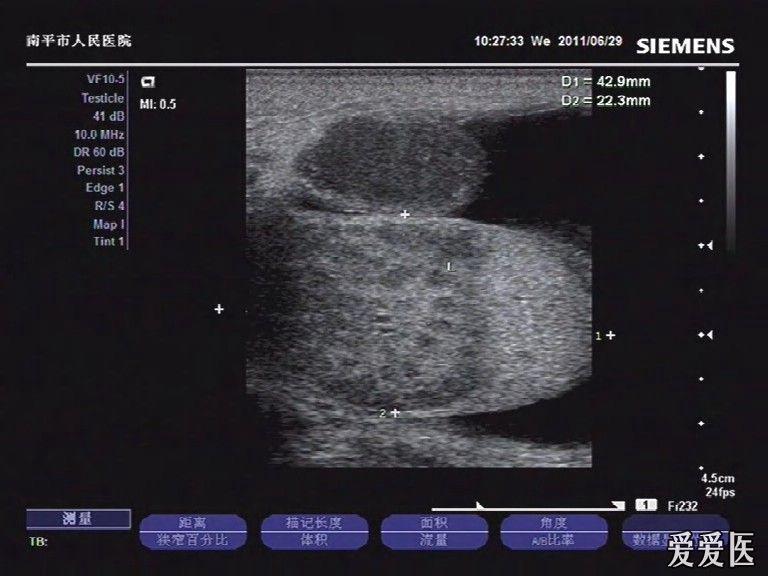 附睾结核图片图片