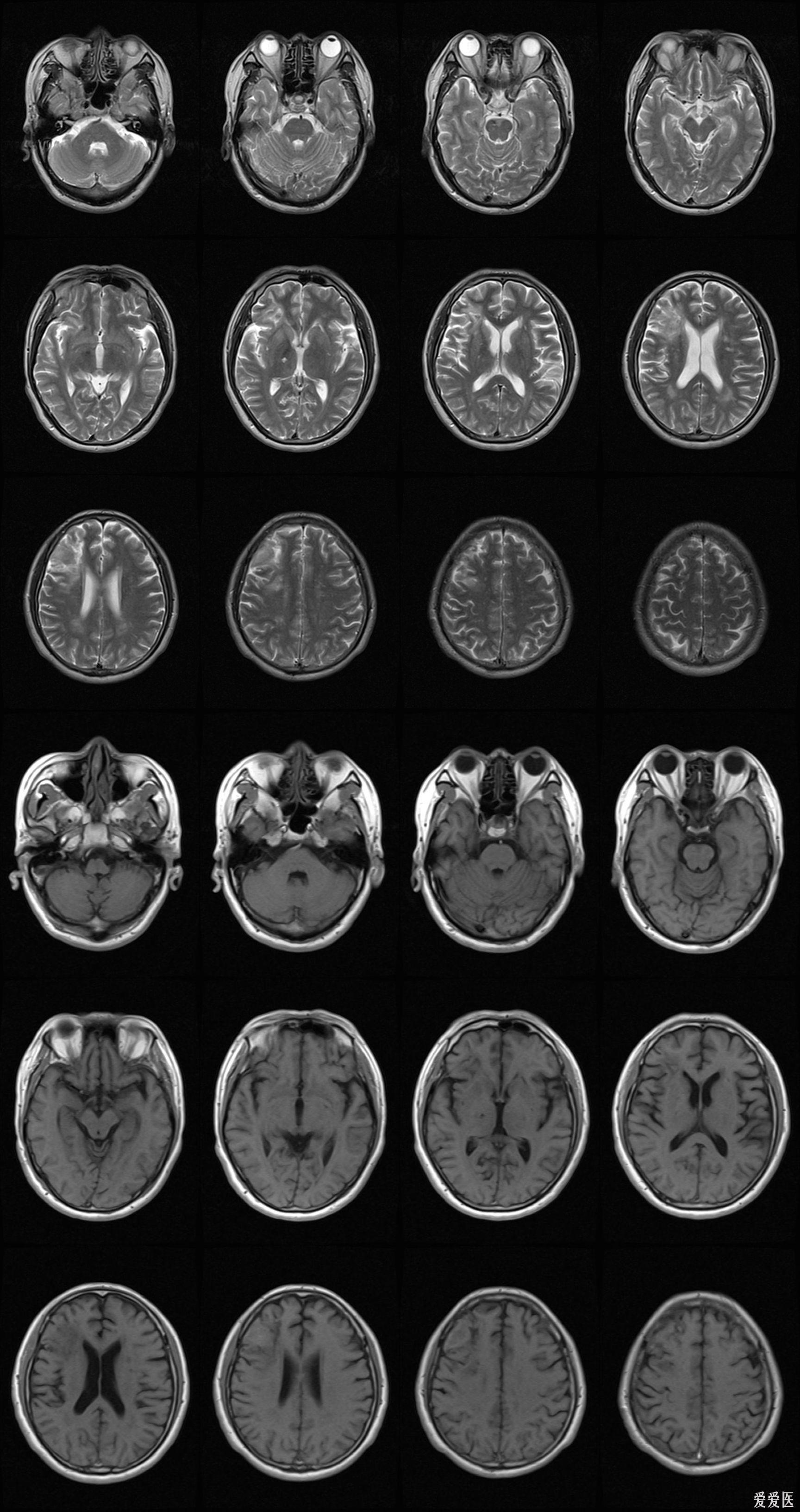 脑磁共振图片