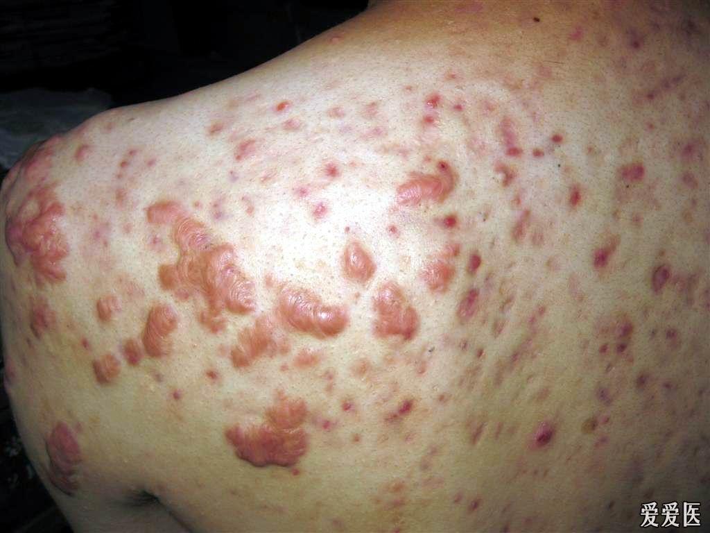 看图识病瘢痕疙瘩性座疮