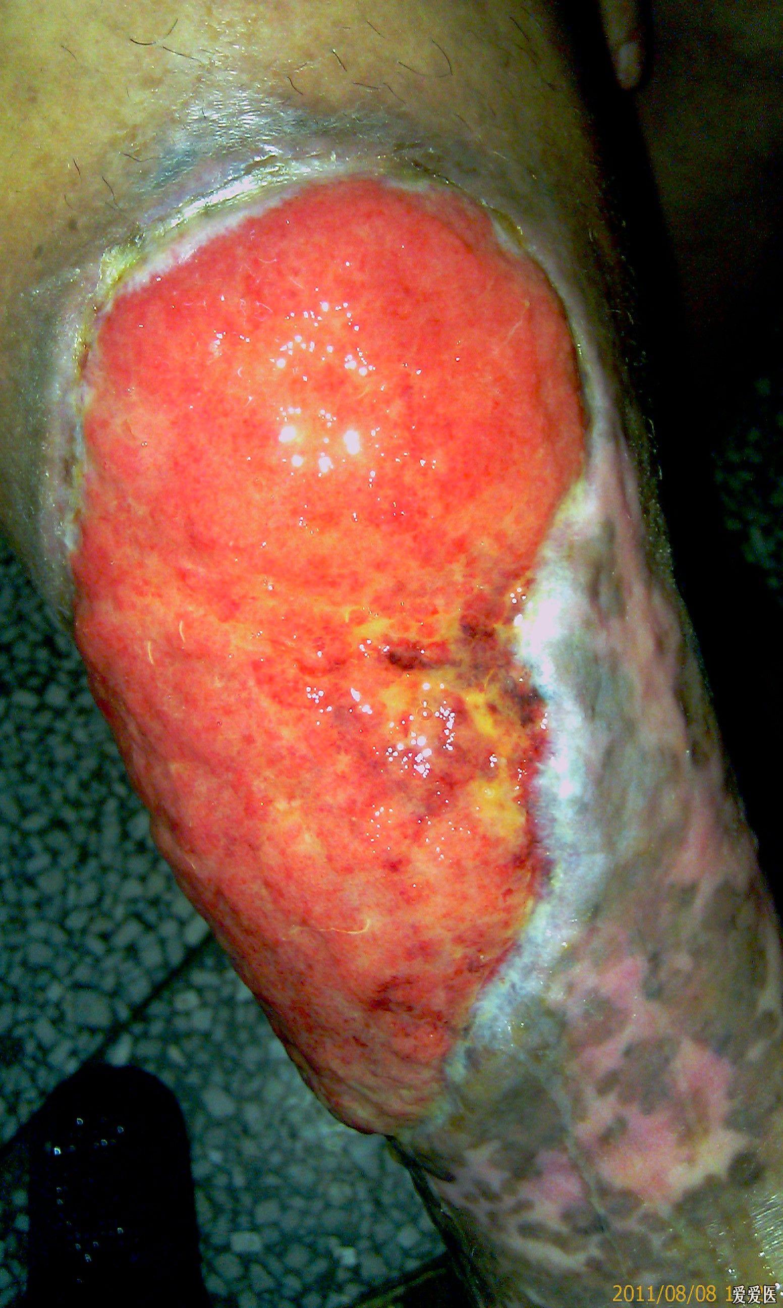 右下肢巨大溃疡